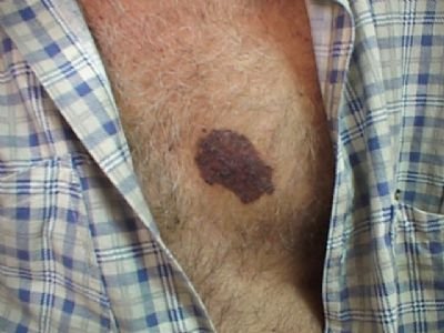סרטן העור במטופלי גזזת