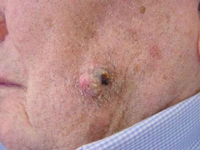 סרטן העור - אבחון טיפול ומעקב