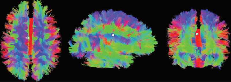 “Diffusion Tensor Imaging and Fiber Tracking Analysis” Introducción al estudio de la microestructura y conectividad del cerebro humano