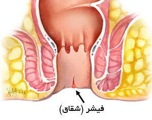 علائم فیشر یا شقاق