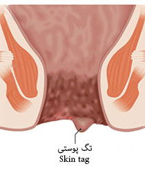 توده های کناری مخرج و ناحیه پرینه