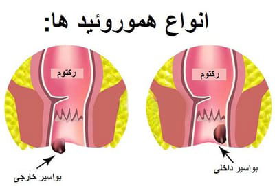 بواسیر چیست؟ image