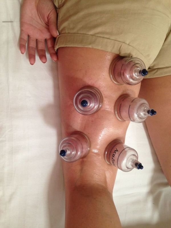 Cupping - Traditional & functional