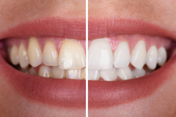 Cosmetic Teeth Whitening
