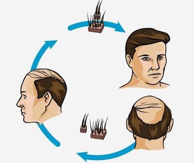 Methods of Medical Hair Restoration image
