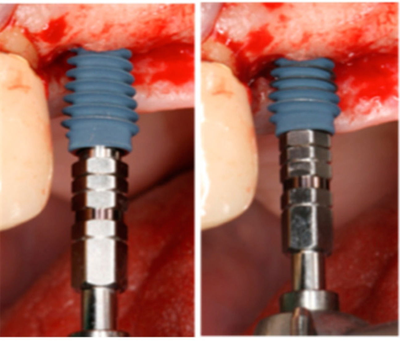 Innovative Dental Implant Design for Immediate Loading and Greater Initial Stability