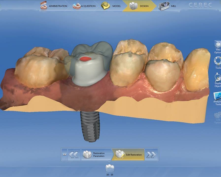 CAD/CAM Workflow for Implant using CEREC System