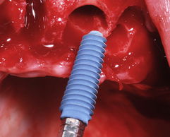 Placing Dental Implants