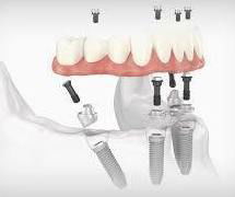 All-on-4 Implant Surgical and Restorative Updates