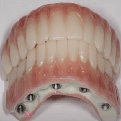 Treatment of the Terminal Dentition and Totally Edentulous Arches