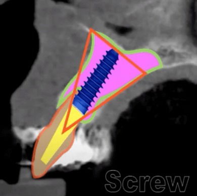 Achieving Success with Immediate Loading of Dental Implants