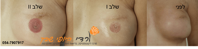 מיקרו-פיגמנטציה (איפור קבוע) image