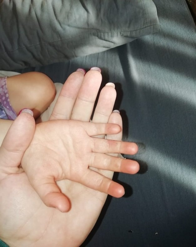Child with hand and foot disease after using AP cream