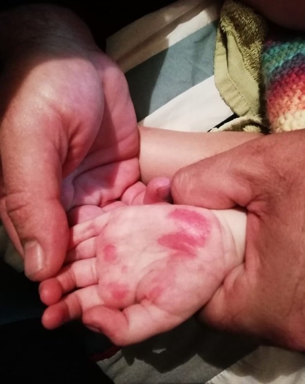 child's hand with mouth and foot disease before using Ap herbal cream