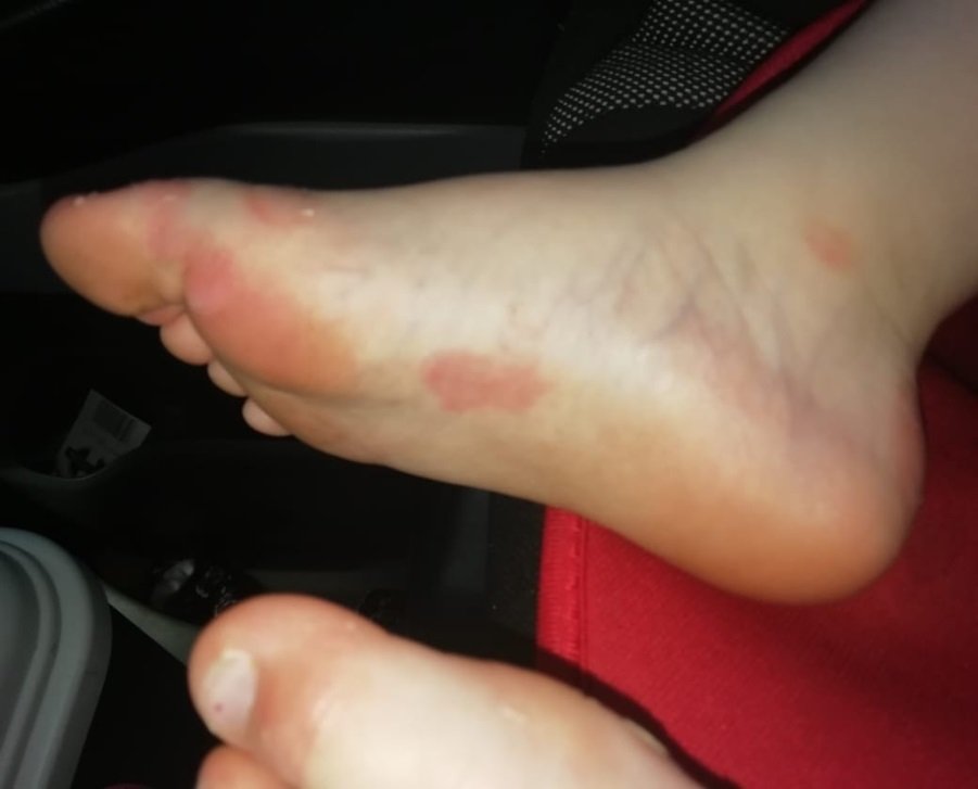Child with hand foot and mouth disease after using AP Herbal cream