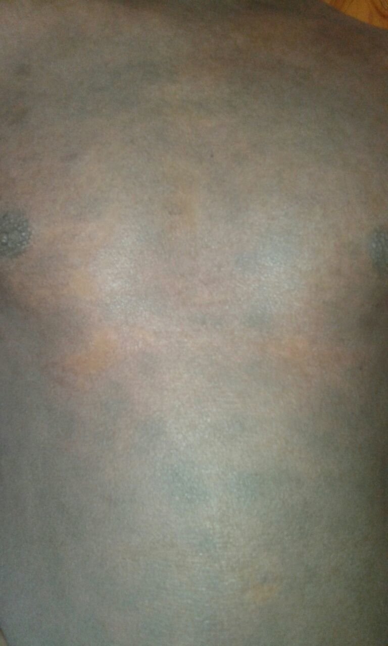 Black man with Psoriasis after 5 days treatment with our Ap herbal cream and capsules