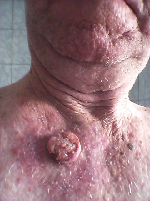 man with cancer carcinoma tumor before treatment with AP Herbal cream and capsules