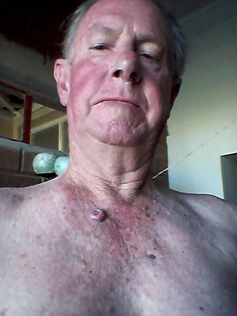 man with Carcinoma tumor after 1 months treatment wit AP Herbal cream