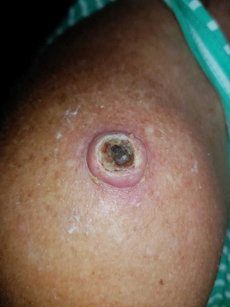 Lady with cancer sore on her shoulder before using AP Herbal cream