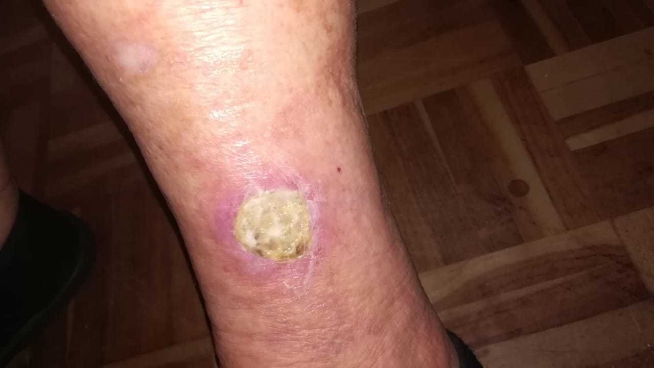An Elderly lady with a vein sore on her leg, before using AP herbal cream