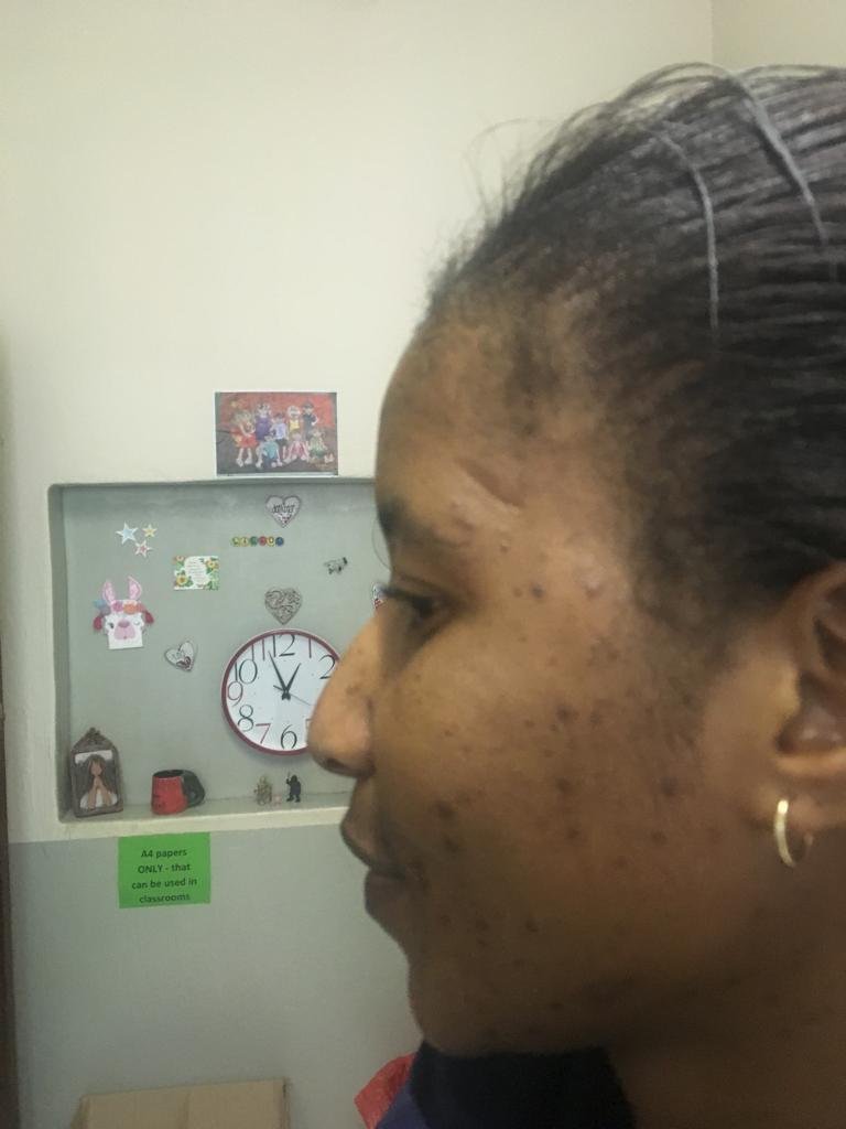 Lady with a very bad acne skin, before using AP Herbal cream