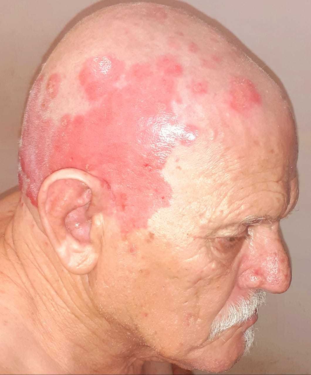 Man with eczema on his head, before using AP Herbal cream with almond oil