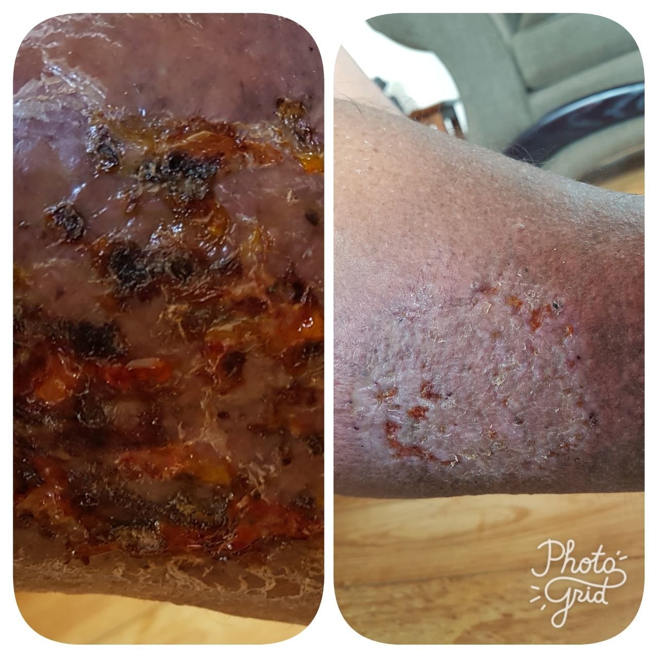 man with cellulitis on his leg, before and after treatment photos