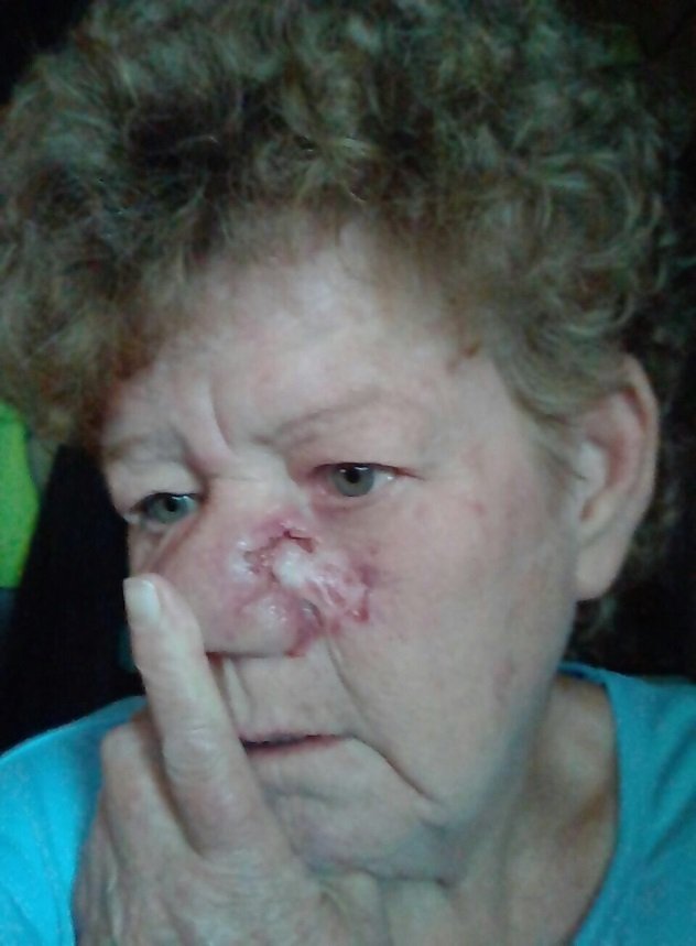 a Lady with a cancer sore on the side of her nose before using AP Herbal cream