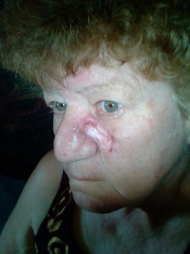 a Women with cancer sore on the side of her nose, after 2 weeks treatment with AP Herbal cream
