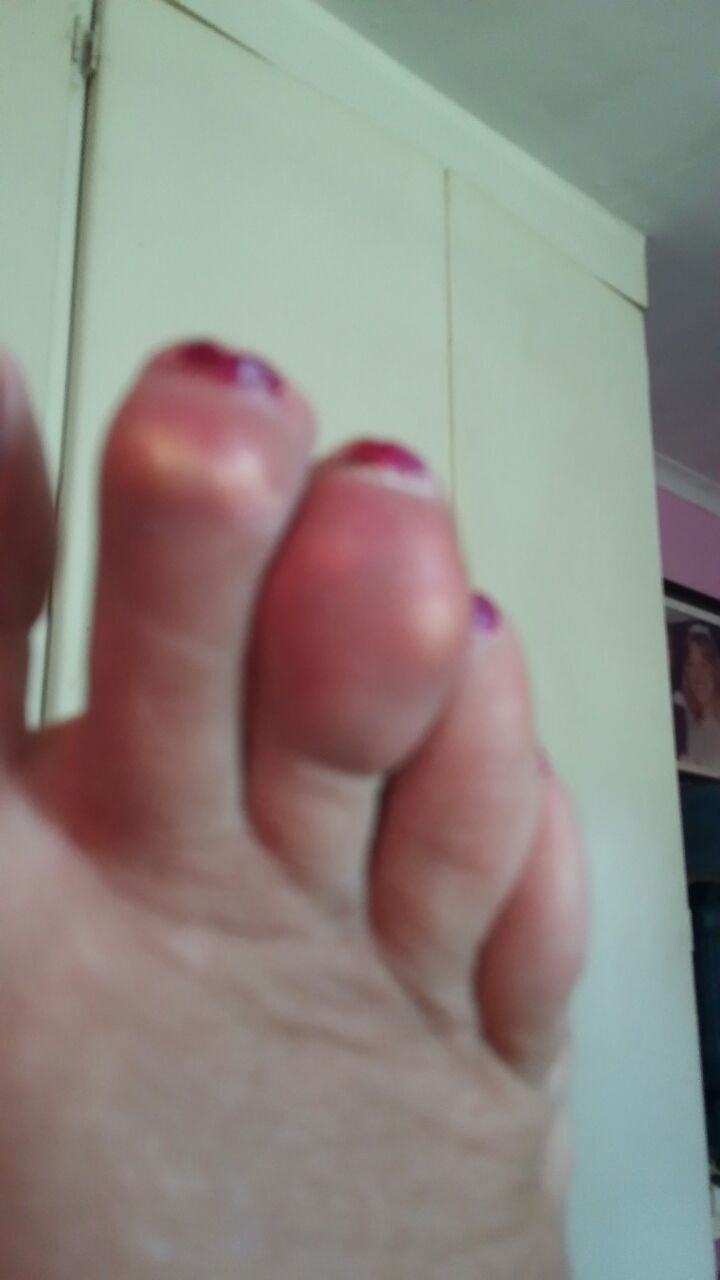 Women with sore on her toe, after 2 weeks treatment with AP Herbal cream