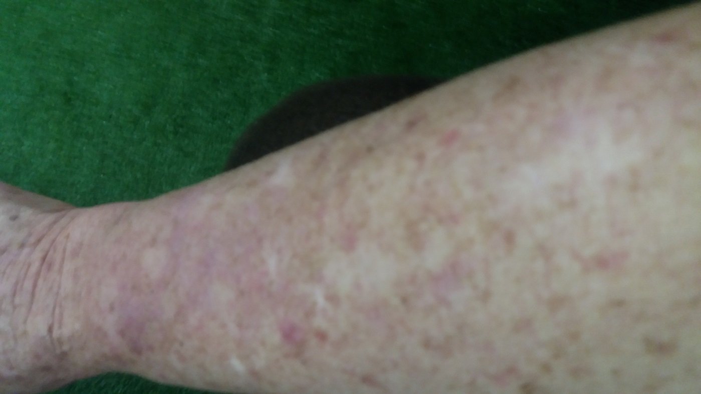 a Ladies arm after treatment with AP Herbal ointment