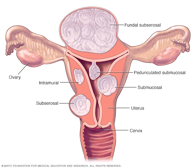 Deaing with Fibroids