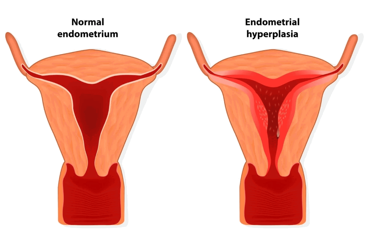 Hyperplasia