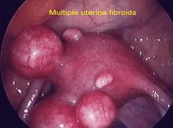 Fibroid Treatments