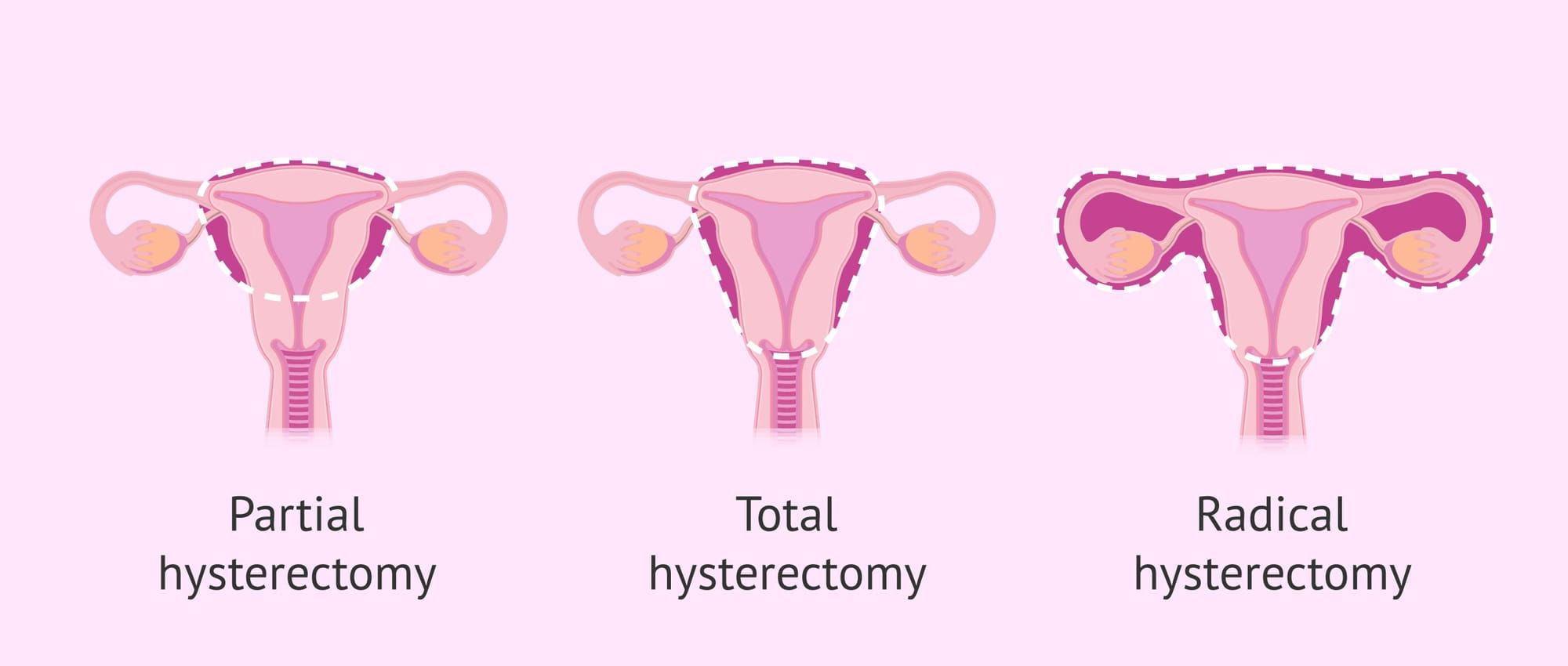 Hysterectomy