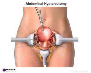 Laparotomy