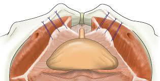 Burch Retropubic Urethroplexy