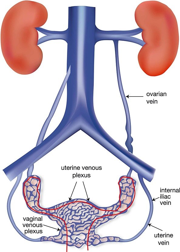Ovarian Vein Embolization