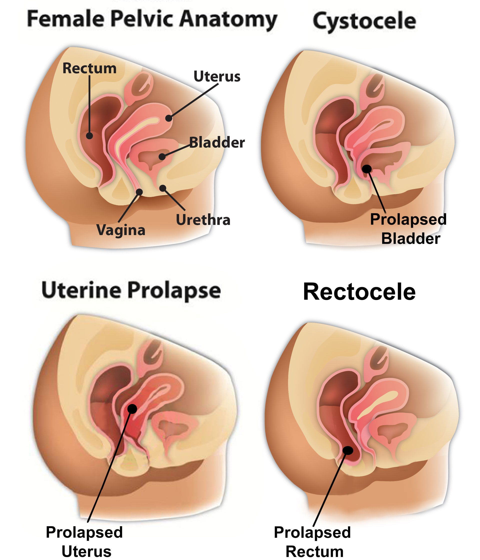 Understanding Cystocele (Prolapsed Bladder)