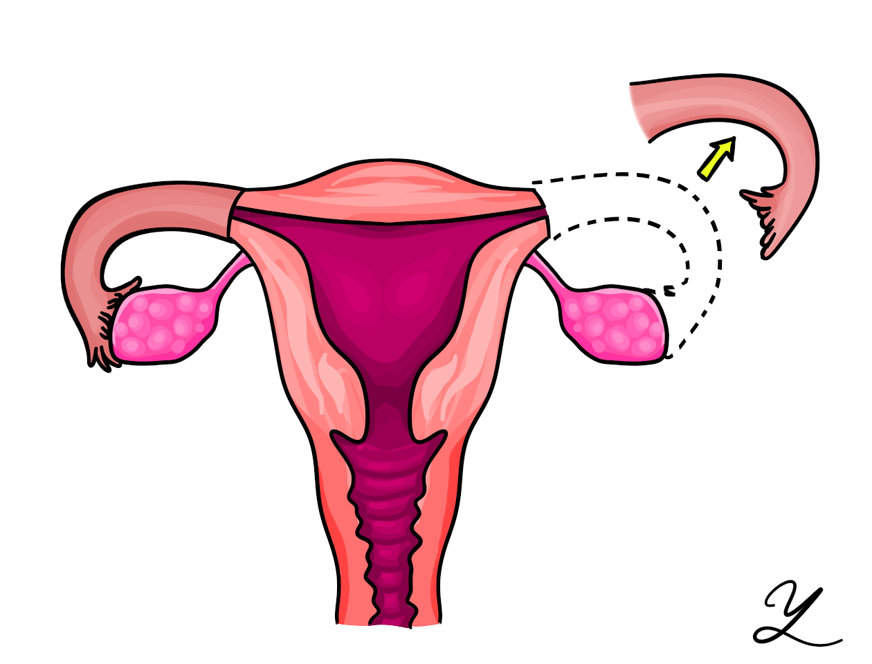 female sterilization