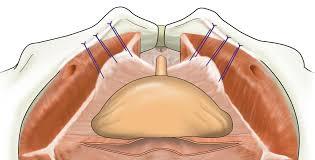 Colporrhaphy (Prolapse Surgery)