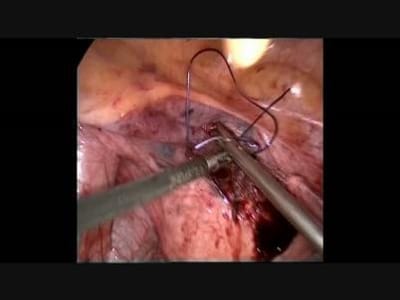 Colporrhaphy (Prolapse Surgery)