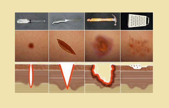 Clasificación De Las Heridas Según Agente Causal Blog De Hemorragias Y Heridas 2158