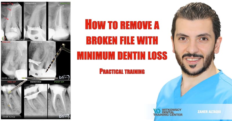 How to remove a broken file with minimum dentin loss