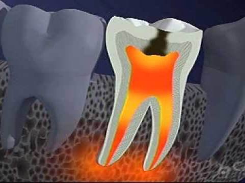 قسم علاج جذور وعصب الأسنان