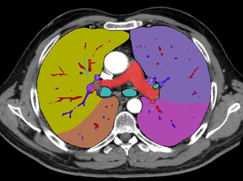 Lung lobes, vessels and airways