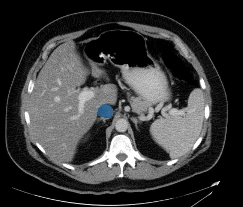 Inferior Vena Cava (20 cases)