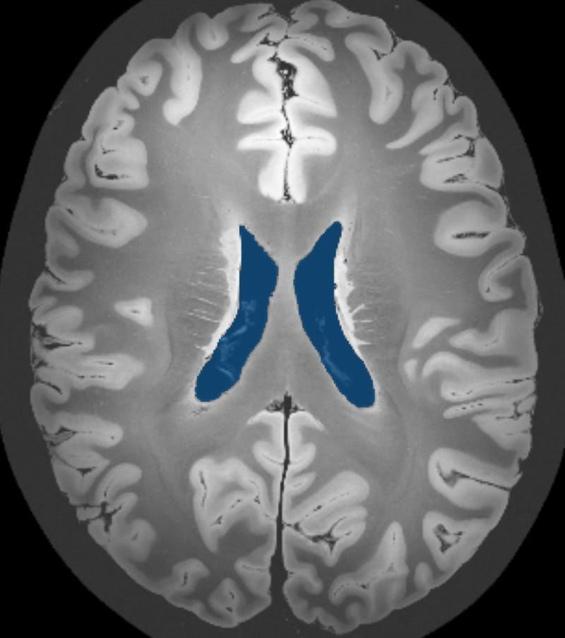 Lateral Ventricles (50 MRI cases)