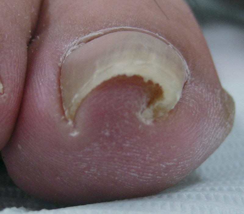 risks-of-diabetic-black-toenail-discoloration-black-toenail-fungus