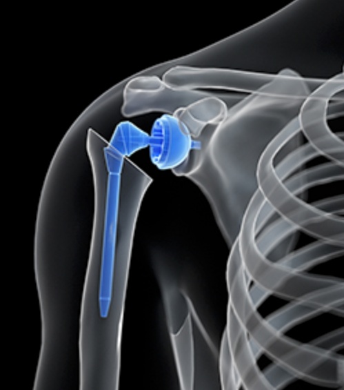 Shoulder Joint Replacement - OrthoInfo - AAOS